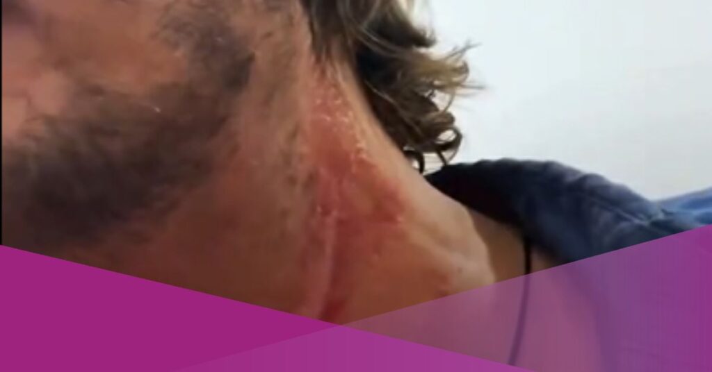 Foreign Tourist Injured After WiFi Cable Wraps Around Neck in Bali
